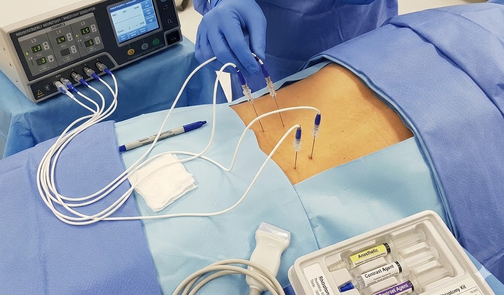 Radiofrequência para alívio da dor crônica na coluna vertebral